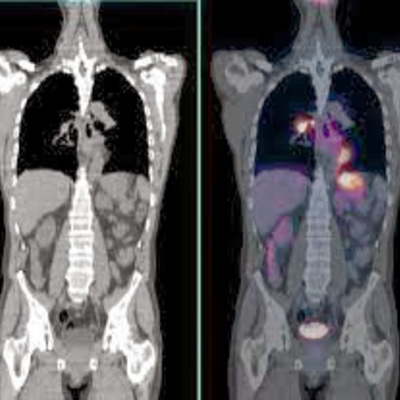 Timeline: Línea del tiempo de la TC (Tomografía Computarizada) y la PET(Tomografía por Emisión de Positrones)