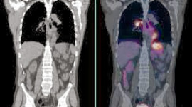 Timeline: Línea del tiempo de la TC (Tomografía Computarizada) y la PET(Tomografía por Emisión de Positrones)