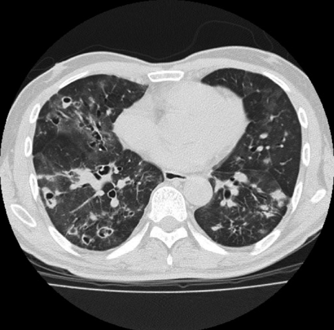 TACs de segunda generación