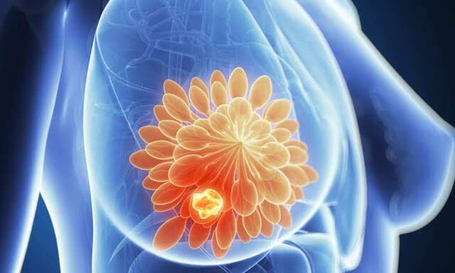 Primer gen del cáncer de mama