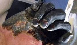 Peste Bubônica - Foto