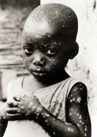 ERRADICACION MUNDIAL