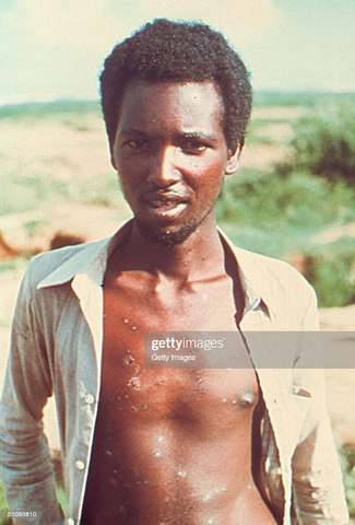 ULTIMO CASO DE VIRUELA