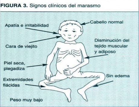 Deficiencia crónica de calorías
