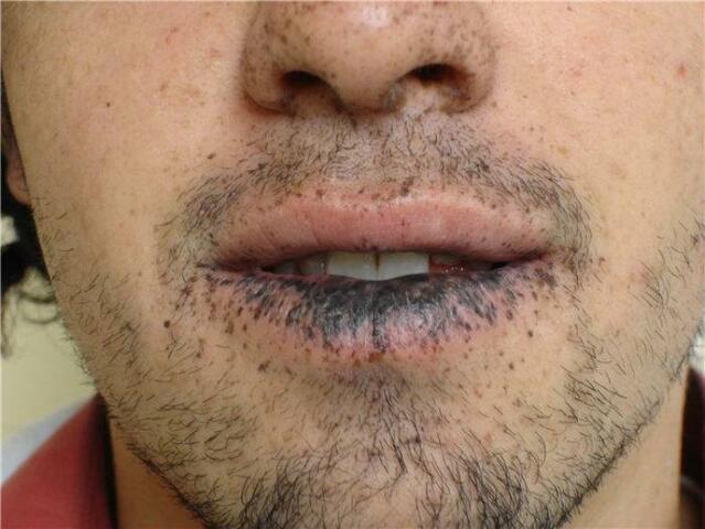 "PRIMERA ENFERMEDAD GENÉTICA"