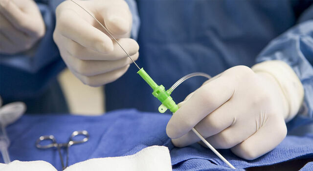 Melvin Judkin utilizo el acceso femoral a travez de la ingle por medio de un catéter para una angiografía coronaria