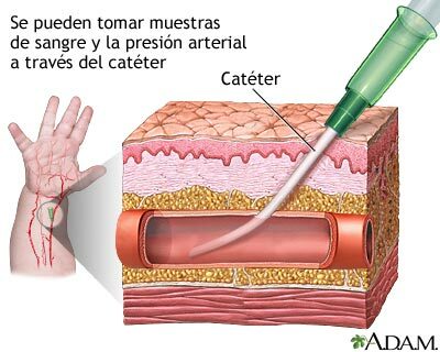 Radner descubrió primer abordaje por vía radial para el estudio cardiovascular y la monitorización de la presión arterial invasiva