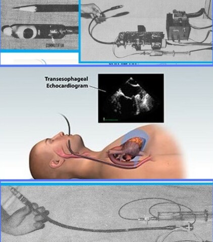 First Transesophageal Echocardiogram