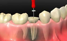 ENDODONCIA