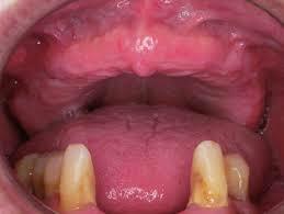 RECESIÓN DE LA MUCOSA