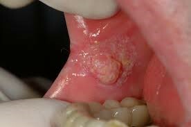 CANCER ORAL