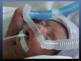 NCPAP