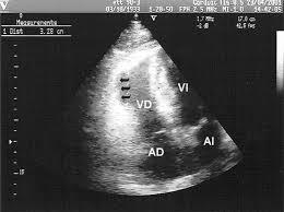 Ecocardiografía pulmonar