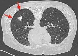 Tomografía computarizada