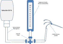 Presión venosa central