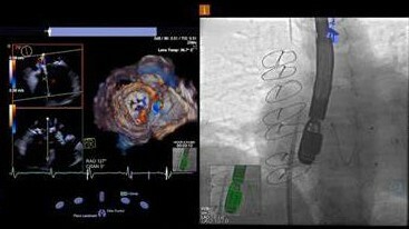Modern Transesophageal Echocardiogram