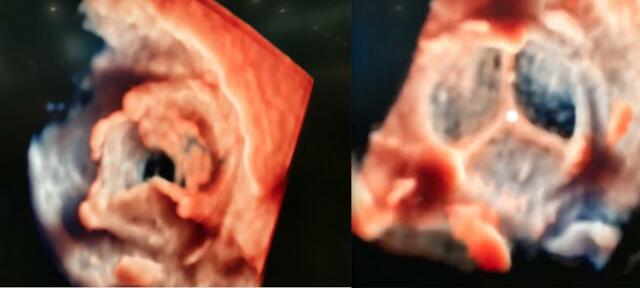 Enhanced 3D Echocardiography