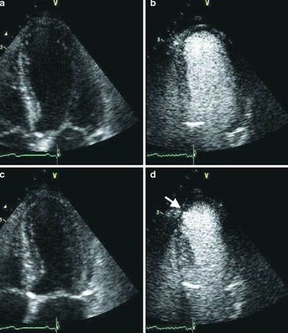 Injectable Ultrasound Enhancements
