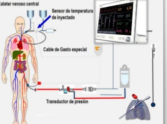 Método de dilución de litio o litiodilución transpulmonar.