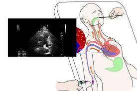 Validez del uso de la sonda eco-doppler esofágica.