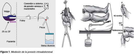 Presión Intragástrica