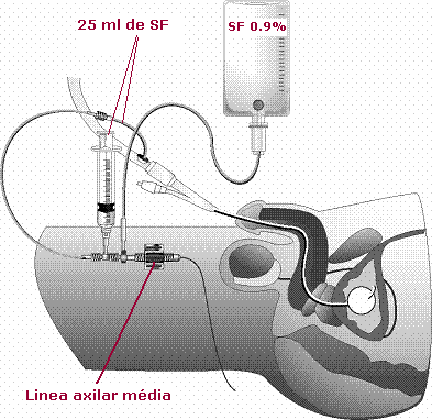Presión Intraabdominal