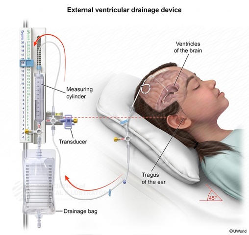 Presión Intracraneal