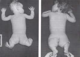 La talidomida es prohibida