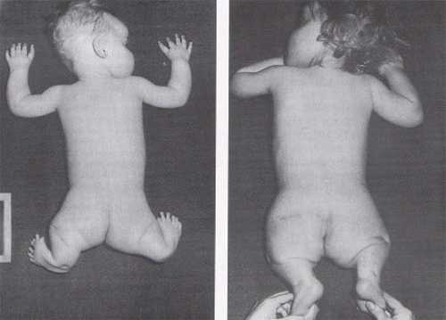 Prohibición de la talidomida en Europa