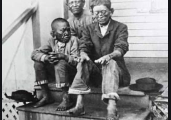 Leprosy in the 11th Century