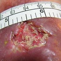 maggots developed where??