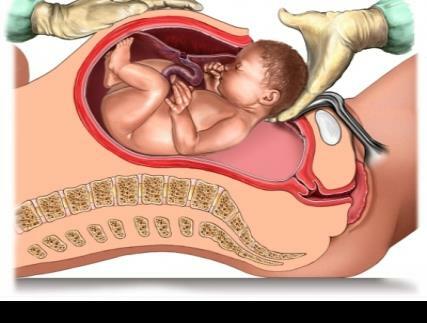 Parto (Por Cesaría)