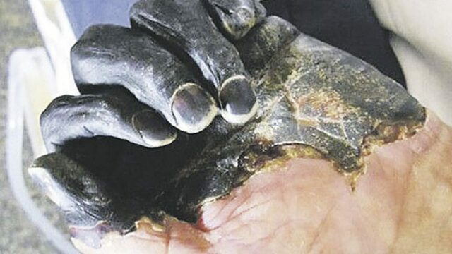 Enfermedad de la muerte negra