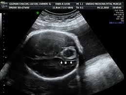 Trombosis fetal (Landsteiner)