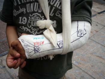 Primera vegada que em trencava un os