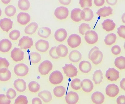 The discovery of corpuscles and globular particles