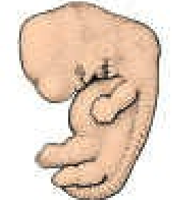 Hernia umbilical fisiológica