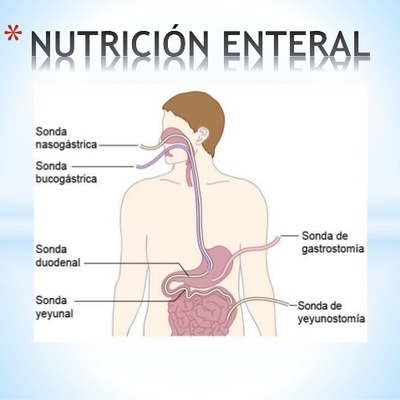 Timeline: Nutrición Enteral