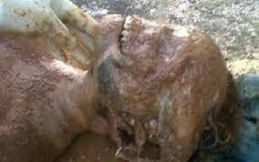 Putrefacción Cadavérica