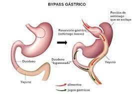 Creación del ByPass