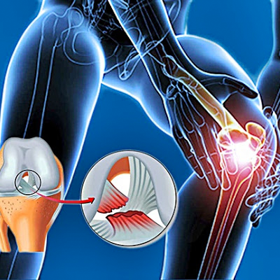 Timeline: Act.4 Lesiones ligamentosas
