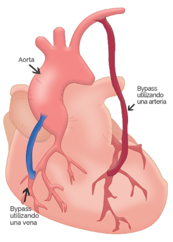 bypass coronario