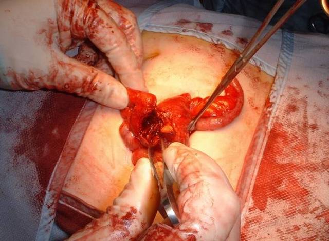Appendectomy