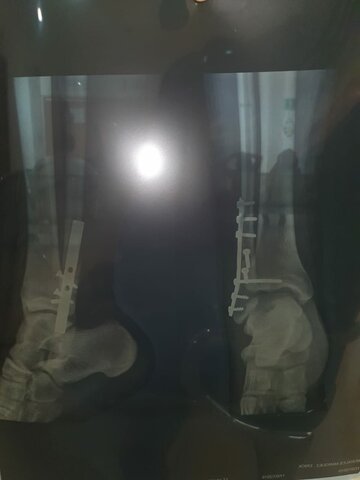 Ruptura de tobillo(operación)