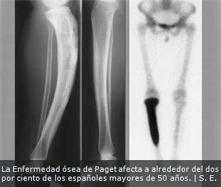 Enfermedad ósea de Paget