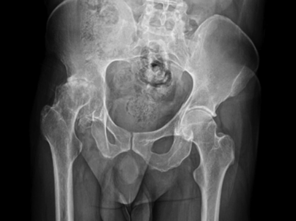 Enfermedad de Legg-Calvé-Perthes