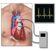 El Monitor Holter
