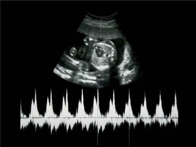 18-20s- La actividad de respiración, movimiento fetal y rimo cardiaco es cíclica