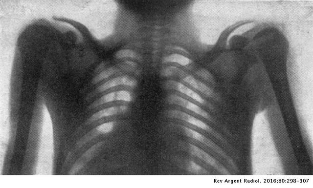 1era Rx de Torax in situ