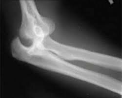 MÉXICO 1era RADIOGRAFÍA